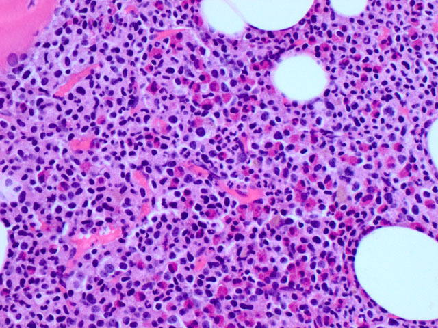 Bone marrow biposy demonstrate a hypercellular marrow with left-shifted granulocytic hyperplasia and marked eosinophilia.  There is no significcant increase in blasts (H&E, 400x).